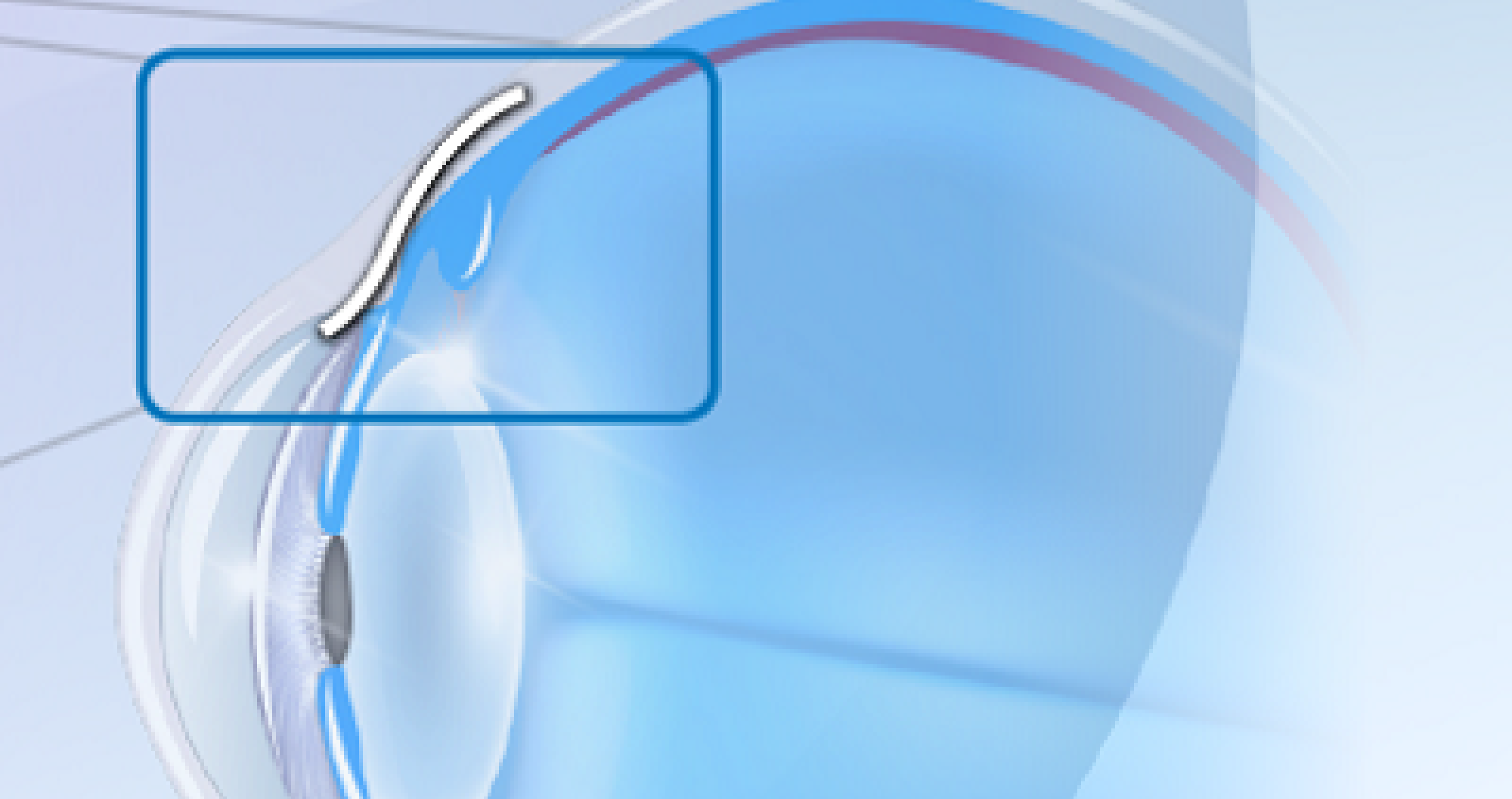 Allergan Voluntary Recall XEN® Gel Implant Australia